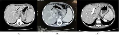 Effectiveness of anticoagulant therapy using heparin combined with Plavix after Rex shunt